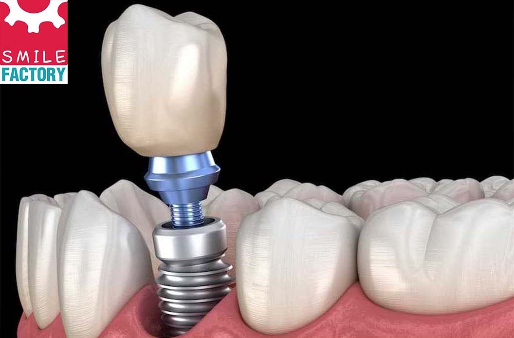 https://smilefactory.in/wp-content/uploads/2022/09/Dental-Implants.jpg